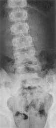 Figure 10. Standing anteroposterior radiograph of a 14 year old male with a 2cm true leg length difference.