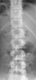Figure 5. Vertebral rotation without lateral angulation. 