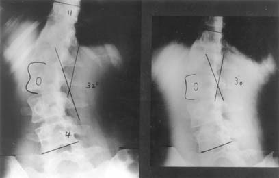 Figure 9. Decompensated left thoracolumbar scoliosis in an adult female