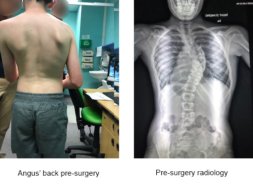 uneven shoulder blades and xray of curve