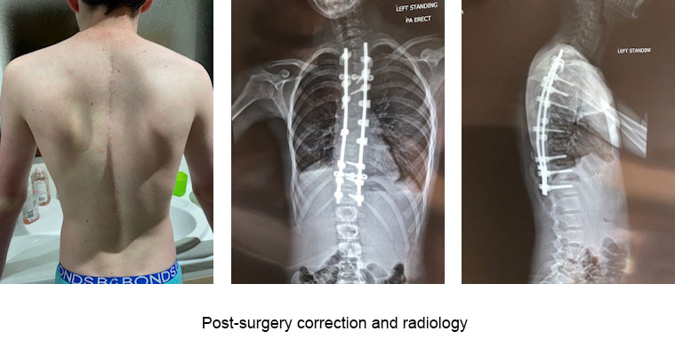 pic of post surgery correction and radiology