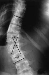 ©2004 Scoliosis Australia Figure 6. A decompensated left lumbar scoliosis with the apex at L1.