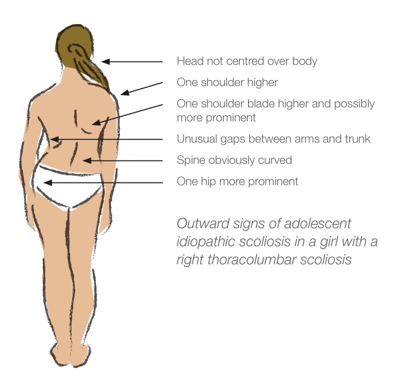 The Outward Signs of Scoliosis